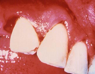 FLUIDO CREVICULAR!!